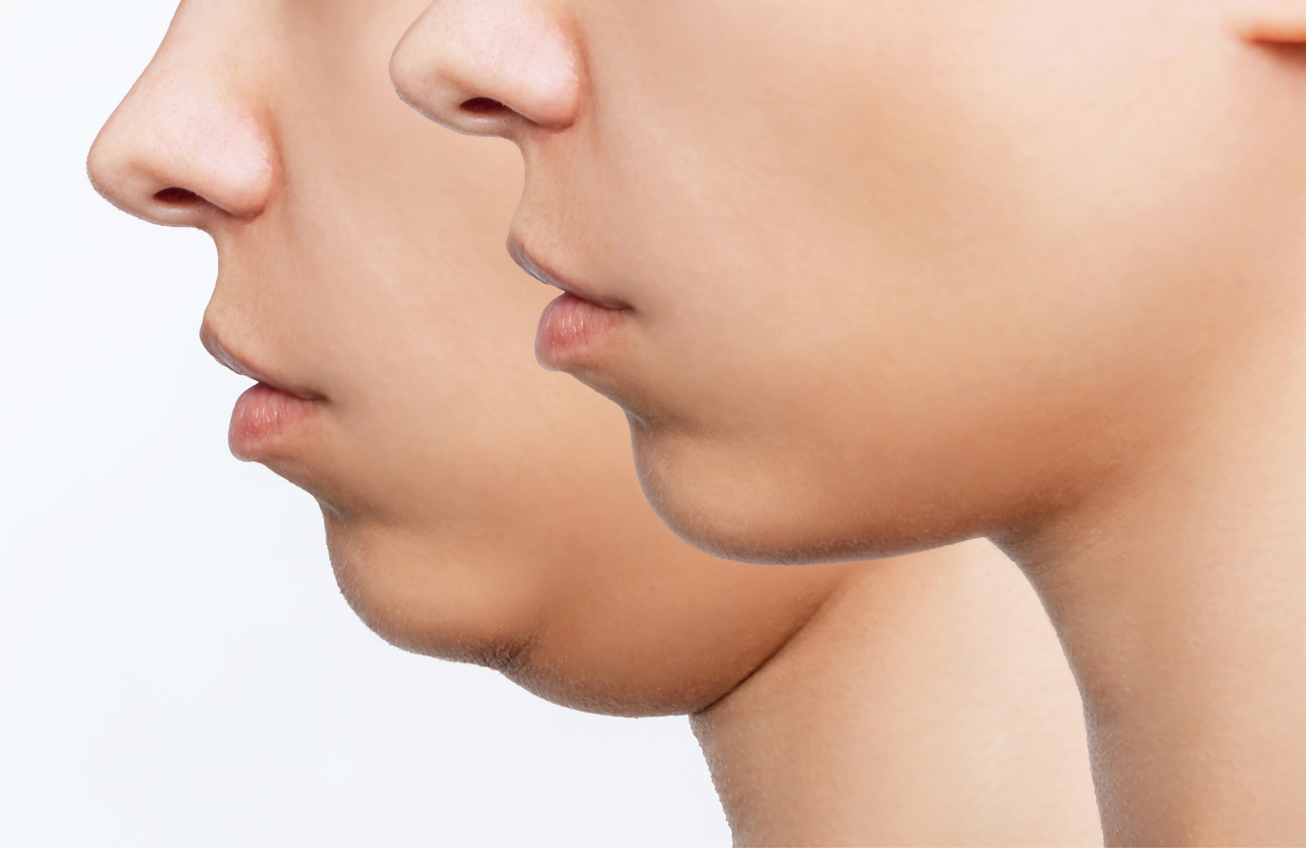 "Tratamiento de rejuvenecimiento facial con láser CO2 Dr. Juan Carlos Mena"